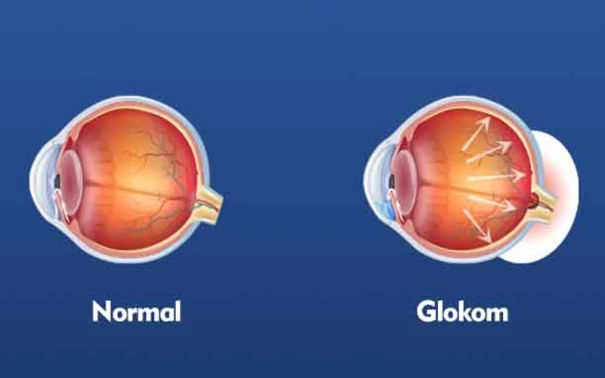 Glokom Nedir? Nelere Dikkat Edilmeli?